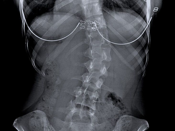 What does the medical term 'dorsolumbar scoliosis' mean? - Quora