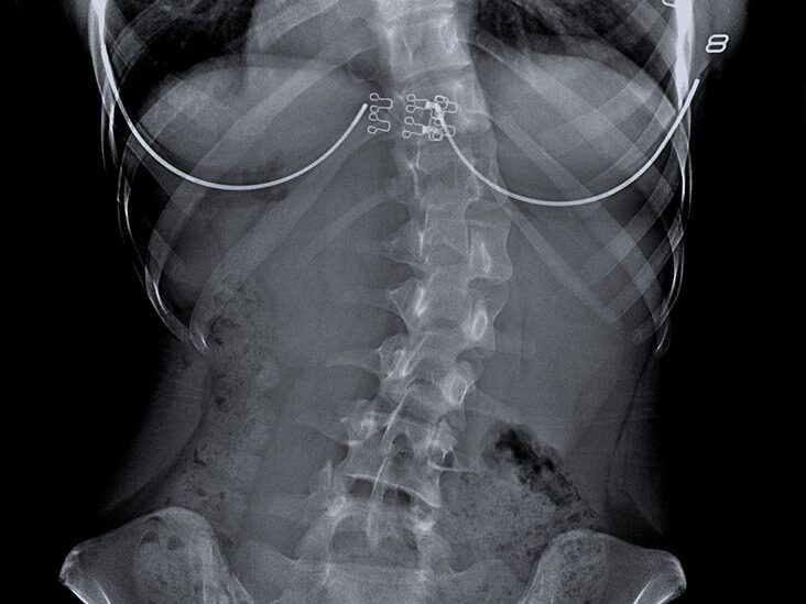 showing dorso lumbar scoliosis with anterior breaking at D12, L1,2