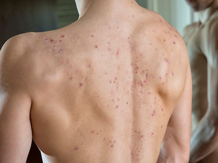 How to Get Rid of Back Acne - Bacne Treatment and Causes