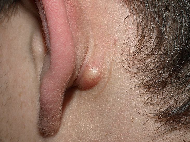 Sebaceous cyst: Removal, infections, and treatment