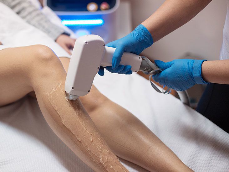 Electrolysis vs. Laser Hair Removal: Which Treatment Works Best?