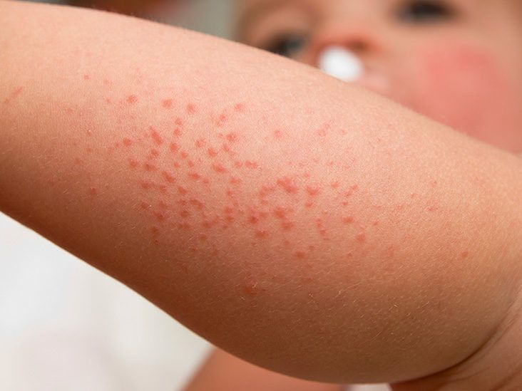 Baby rash: Causes and when to see a doctor