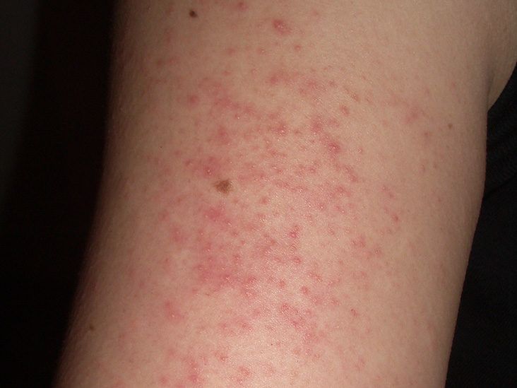 Itchy rash on sale under arms