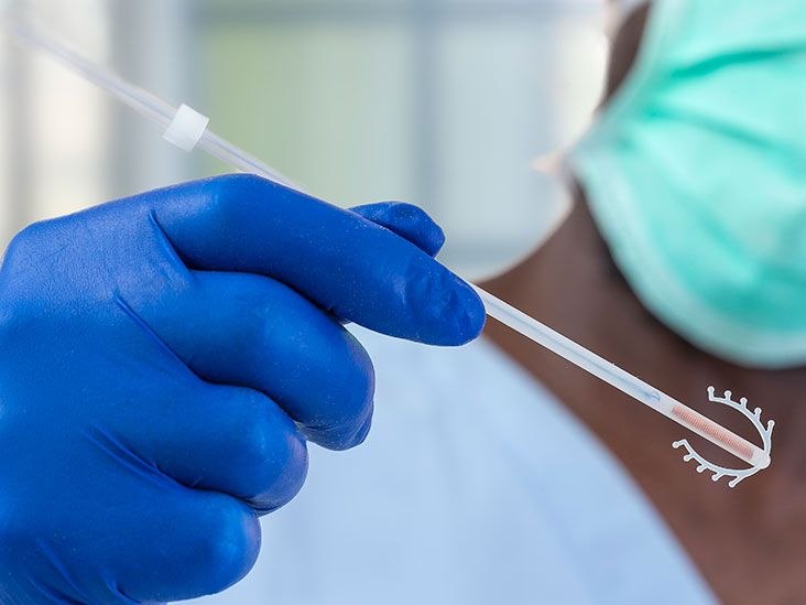 Copper IUD Efficacy, benefits, side effects, and procedure