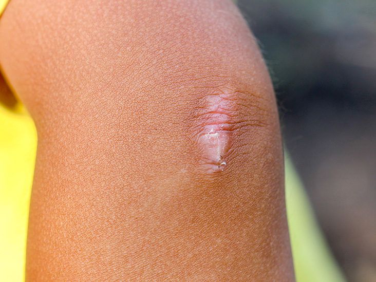 Can I Avoid Scar Tissue After Surgery?