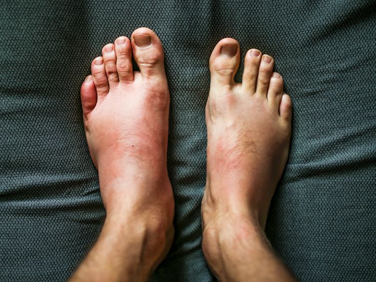 Why Does Swelling Occur After an Injury?