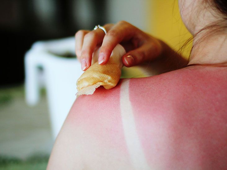 Sunburn relief: Home remedies and medical treatments