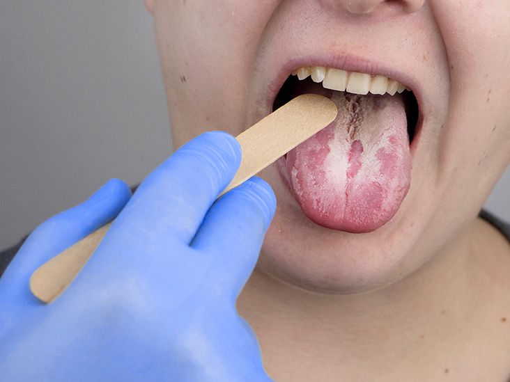Yeast infection in mouth: Causes, treatment, and prevention