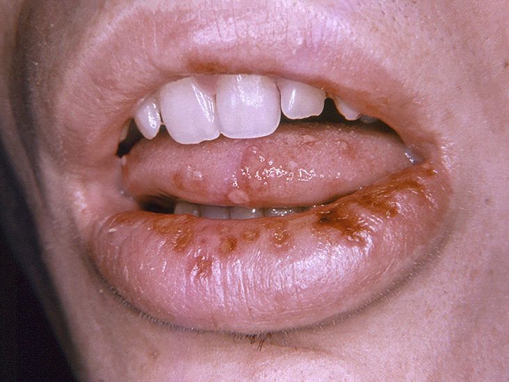 Lip Lightening - Treatment to Get Rid of Smoker's Black Lips | Kaya Skin  Clinic