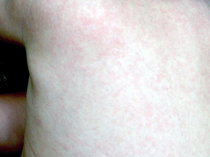 Red bumps/rash on breasts - pics included - January 2023 Babies, Forums