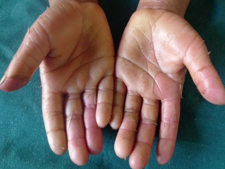 10 Effective Home Remedies To Stop Peeling Of The Fingertips