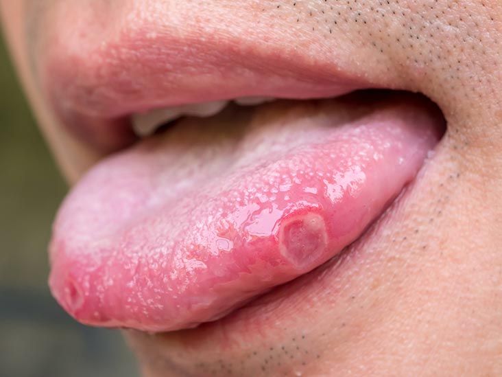 Chapped Lips: 5 Home Remedies to Heal Dry Lips Naturally