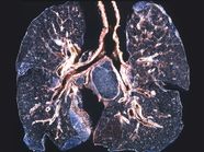 Black Lung Definition Symptoms And When To Seek Help