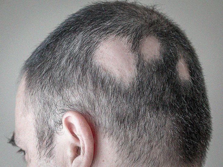 Scalp conditions Examples, treatment, and pictures