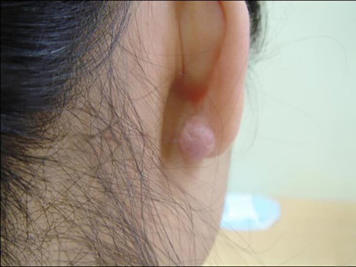 Keloid Post-Operative Pressure Earrings