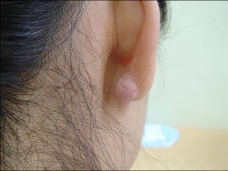 Torn ear lobe solutions, monster backs and more