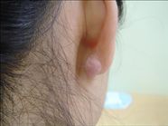 Keloid On Ear Causes Treatment And Prevention