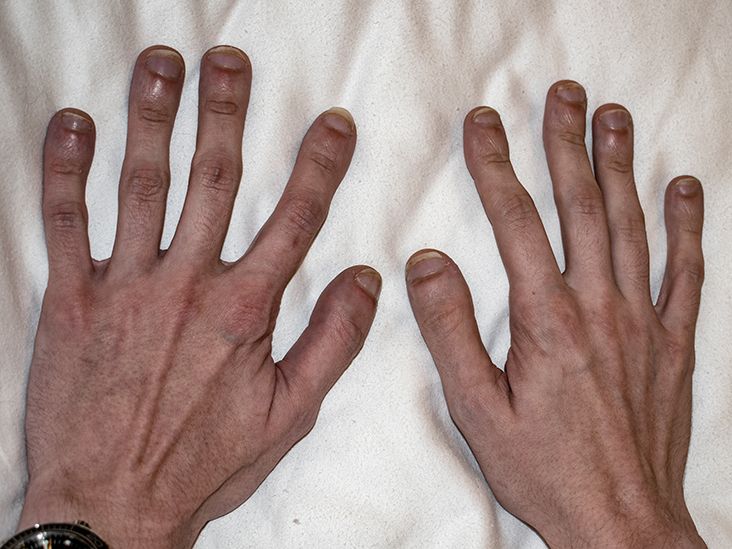 LOCAL CIRCULATORY CHANGES ASSOCIATED WITH CLUBBING OF THE FINGERS AND TOES