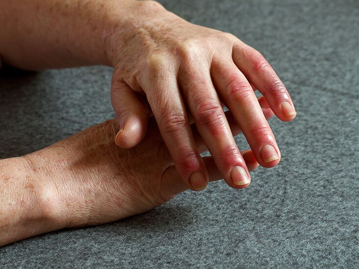 Artrosis en las manos, Remedios naturales artrosis dedos