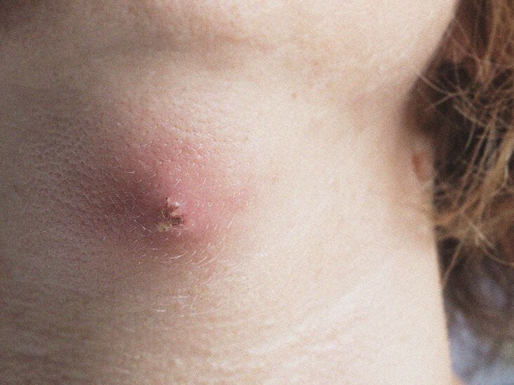 Skin abscess: Pictures, symptoms, causes, and treatment