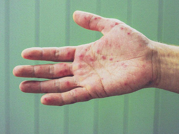 A patient with breast cancer and a rash on her hands and feet