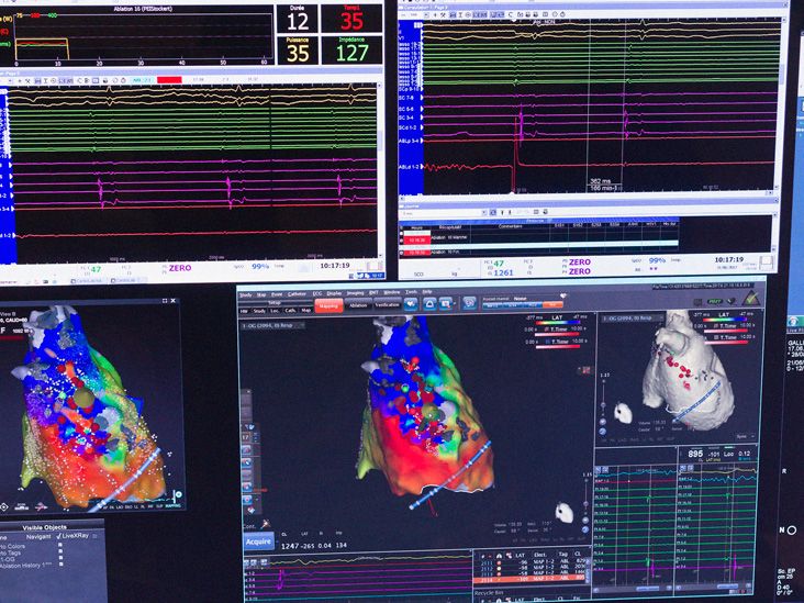 Cardiac ablation surgery Types, risks, what to expect, and more