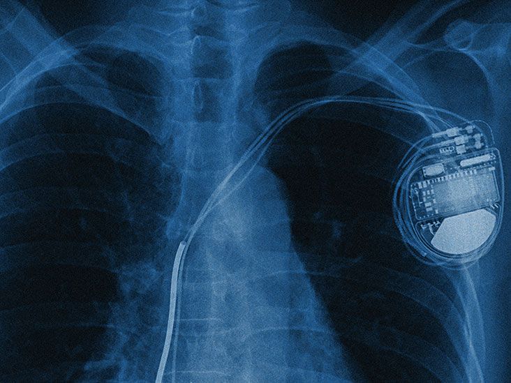 Does Medicare provide cover for pacemakers?