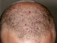 Bumps On The Scalp Causes Symptoms And Treatments