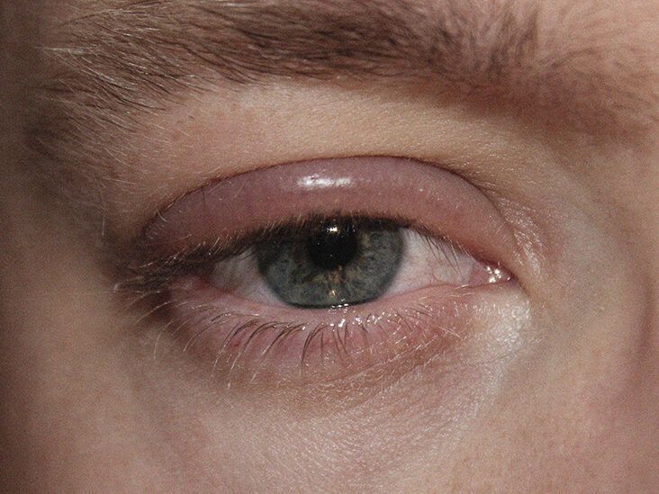 White Stringy Mucus in Eye - CorneaCare