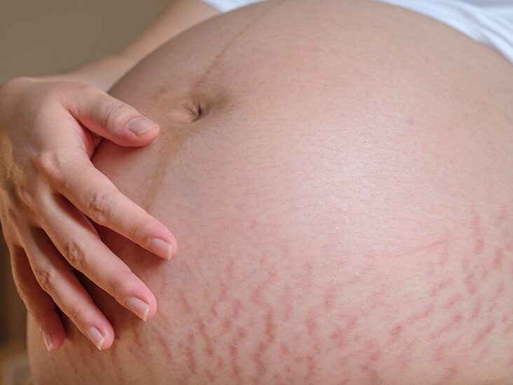 Mums & Chums - What with these stretch marks? 1. Use specially formulated  cream or oils 2. Start as soon as you find you are pregnant 3. Prevention  measures are better than
