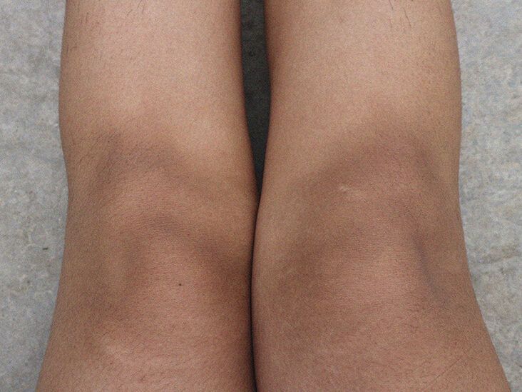 Dark knees: Causes and home treatment