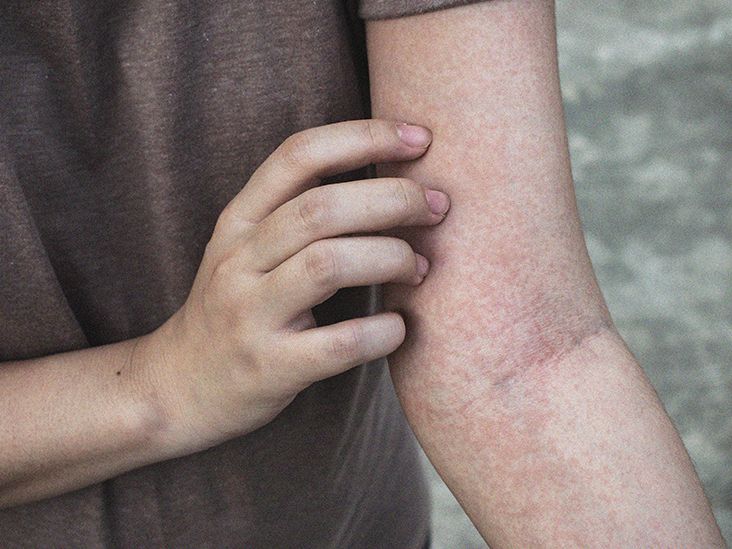 non-blanching-rash-is-it-serious-causes-in-adults-and-children