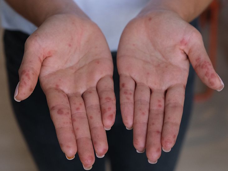 A patient with breast cancer and a rash on her hands and feet