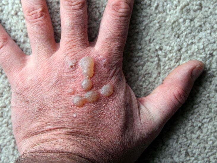 Itchy bumps filled with clear liquid: Causes and treatment