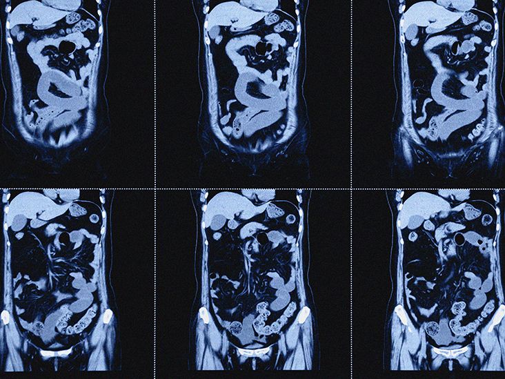 SEER Training: Small & Large Intestine