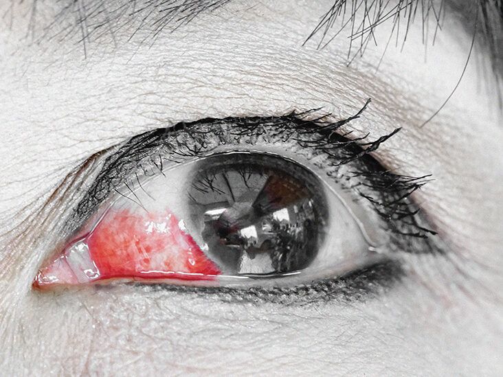 Eye bleeding: Types, causes, treatment, and seeking help
