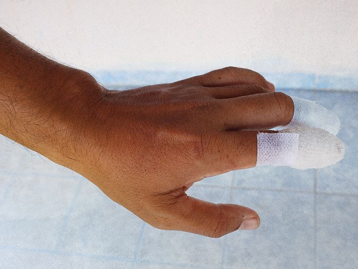 Cut Finger: First Aid Treatment, Aftercare, and Recovery Timeline