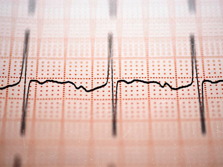 Heart failure: New electric mesh device gives the heart an