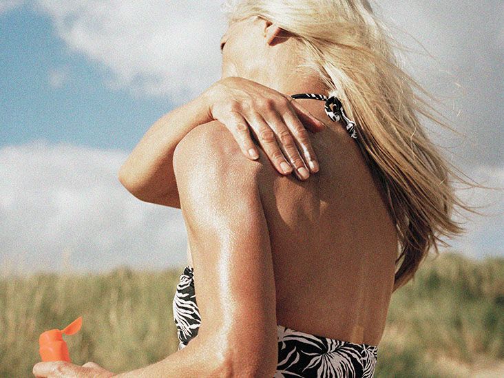 Sunburn severity First and seconddegree symptoms