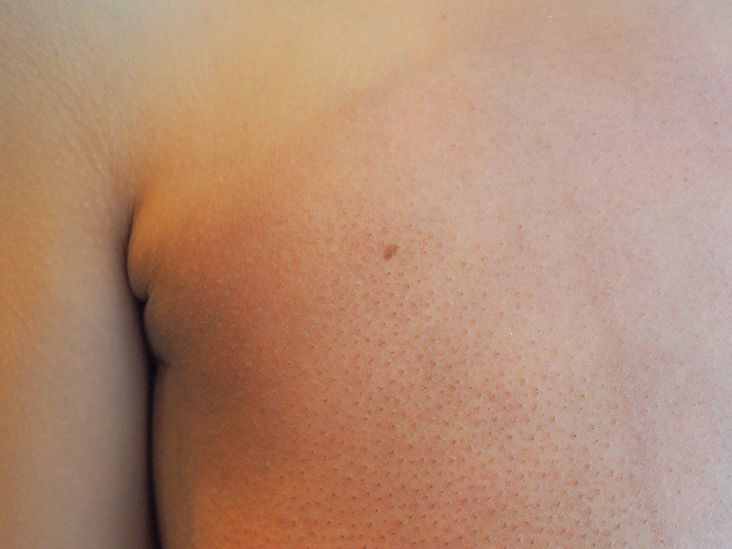 Red circle under breast. Slight burning. Been here for 3 days. :  r/DermatologyQuestions