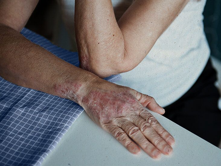 Little Stretches, Big Differences: National Psoriasis Foundation