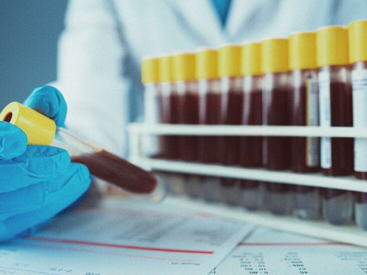 What to know about high triglyceride symptoms