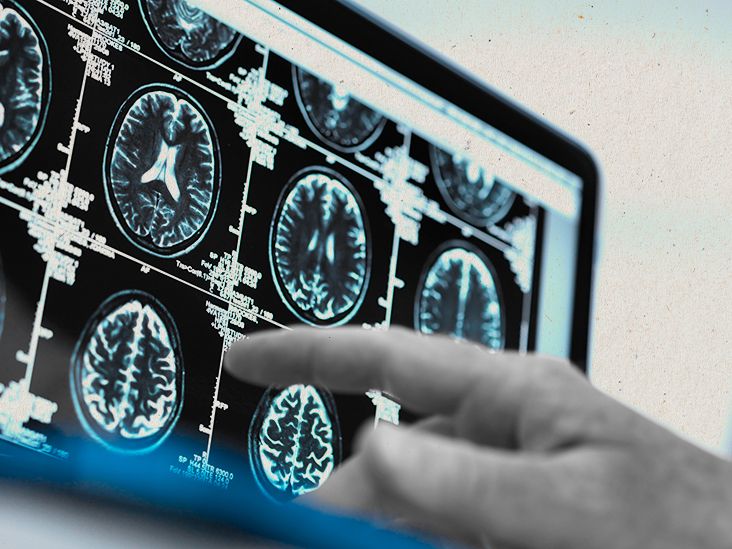 What is central nervous system (CNS) lymphoma