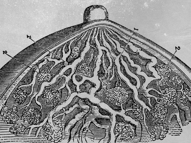 What to know about the different types of breast cancer