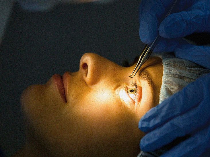 Lasik eye deals surgery near me