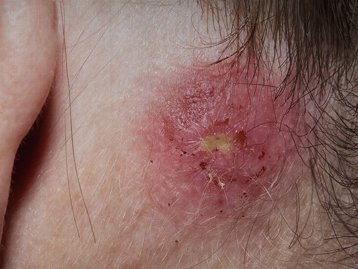 Pustules on the back possibly triggering toxic-shock syndrome