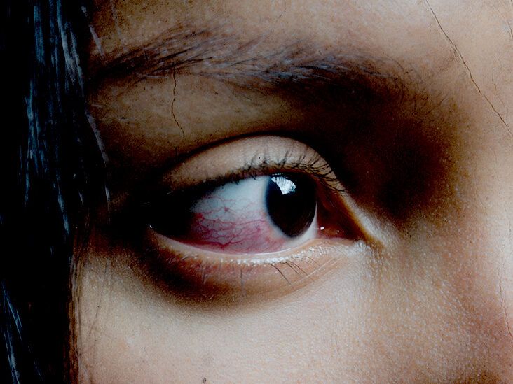 Eye melanoma: Symptoms, causes, and risk factors