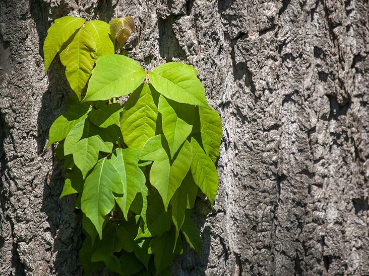 How to Treat a Poison Ivy Rash at Home