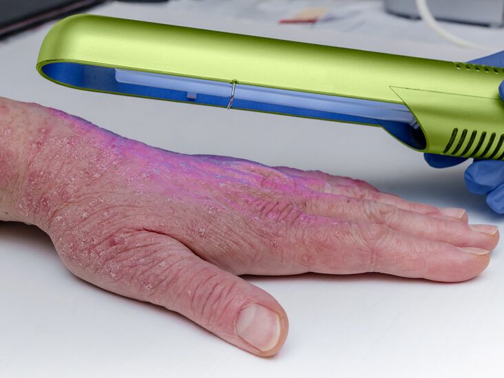 A guide to home phototherapy for psoriasis