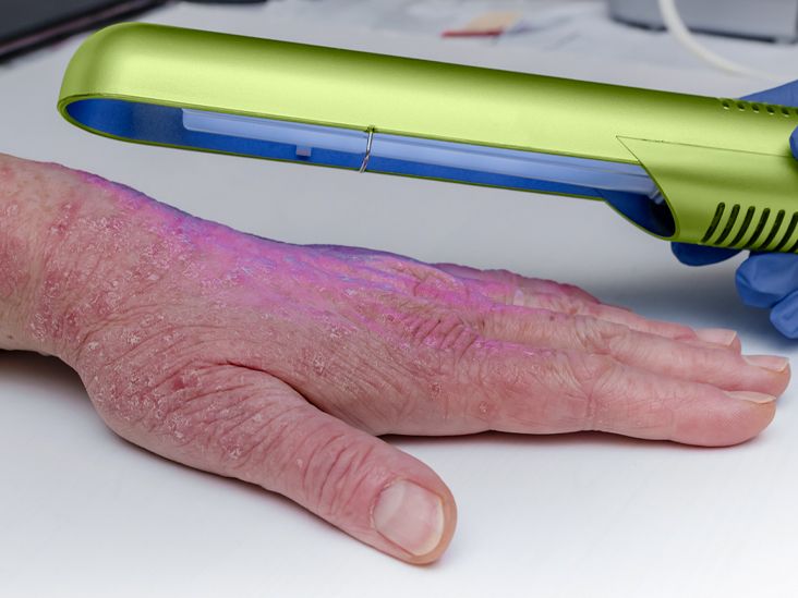 Home phototherapy for psoriasis Function, how to use, cost